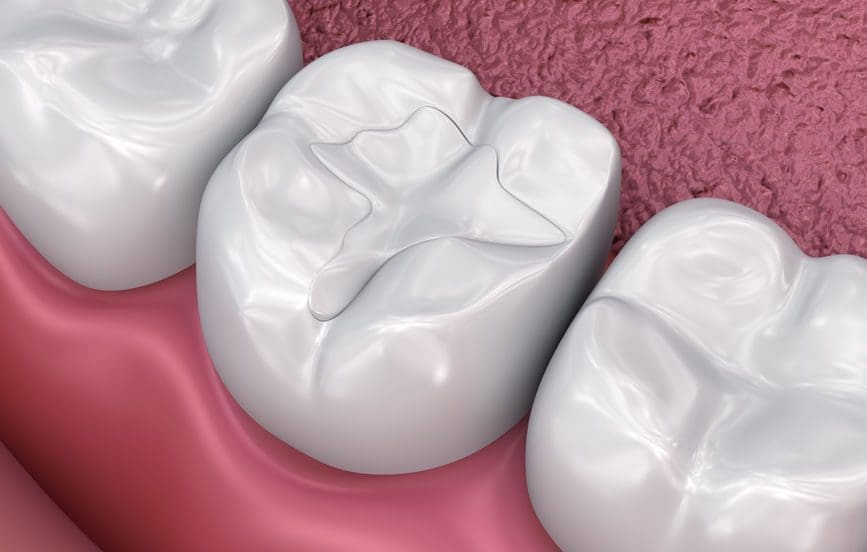 dental-fillings