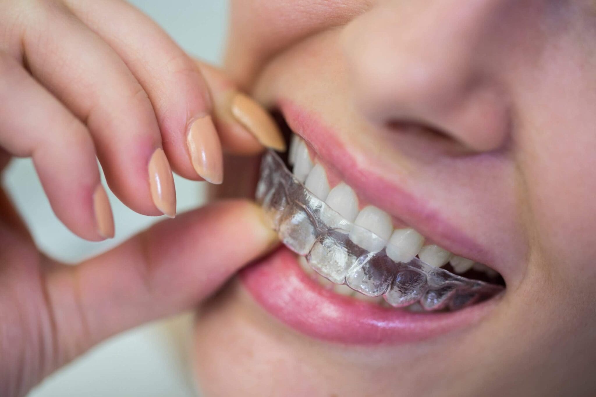 invisalign-scaled