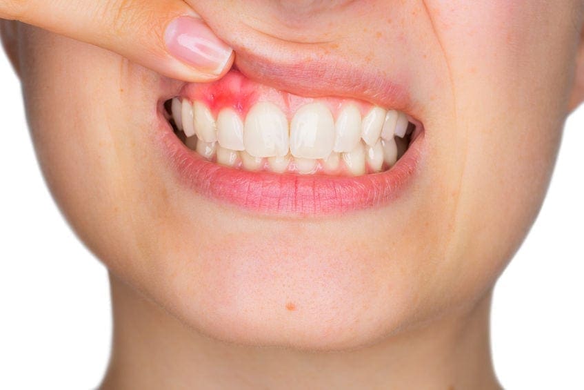 What Causes Mouth Sores? Tips to Treat and Prevent Them
