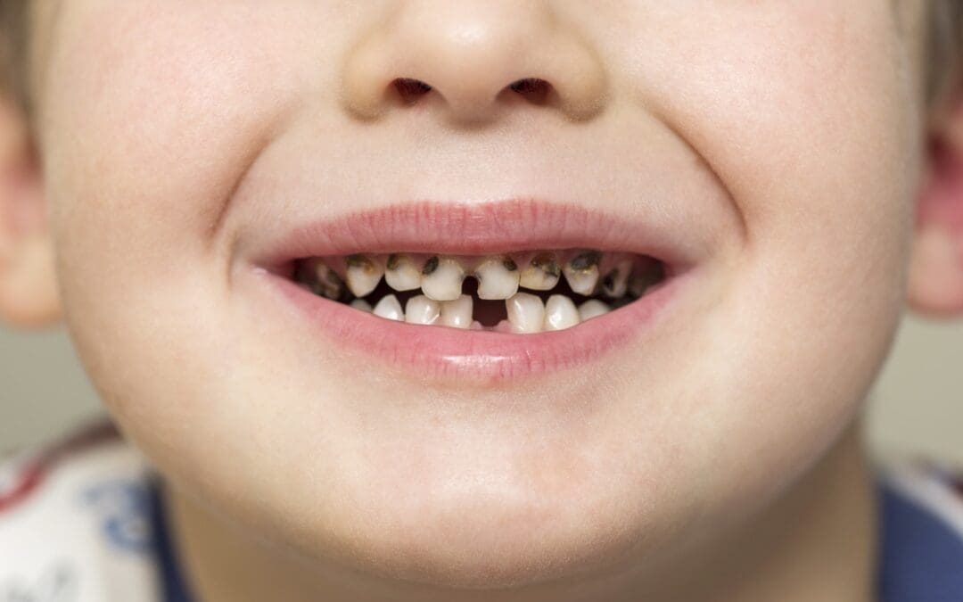 Child Rotten Teeth