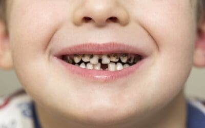 Child Rotten Teeth